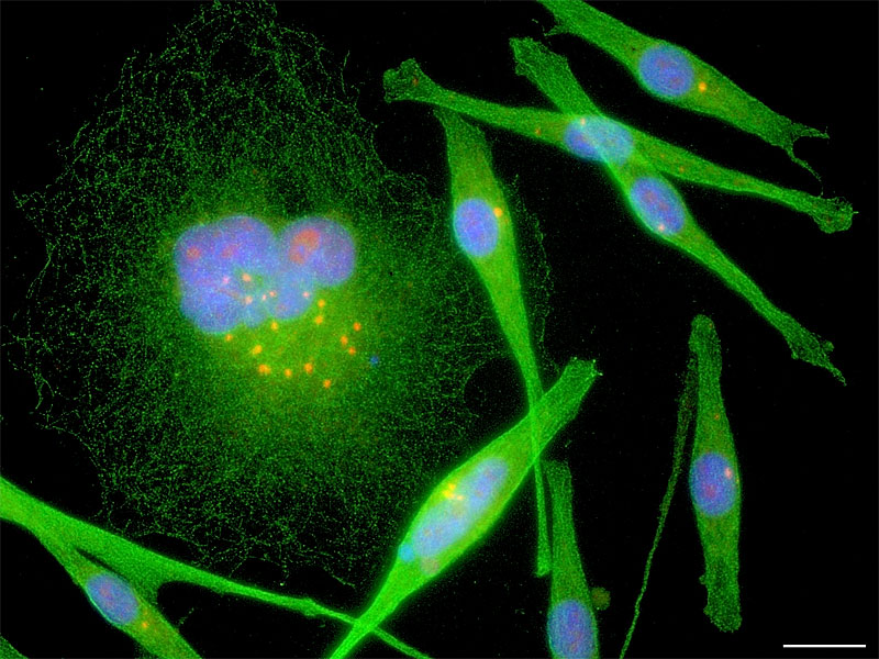Constellation: an award winning fluorescence microscopy image showing centrosomal numerical dysregulation in melanoma